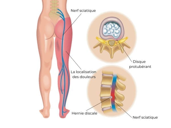 découvrez les causes et symptômes de la sciatique droite. cette condition peut provoquer des douleurs intenses dans le bas du dos et les jambes. informez-vous sur les facteurs déclenchants et les signes à surveiller pour mieux gérer cette affection.