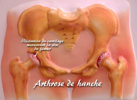 découvrez les causes et solutions pour soulager la douleur à la hanche gauche. apprenez à identifier les symptômes, les traitements disponibles et les conseils pratiques pour améliorer votre confort au quotidien.