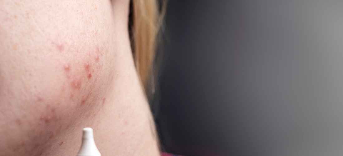 découvrez les significations cachées derrière l'apparition d'un bouton sur le menton. explorez les causes possibles, vos émotions et les liens avec la santé de votre peau. informez-vous pour mieux comprendre votre corps et trouver les solutions adaptées.