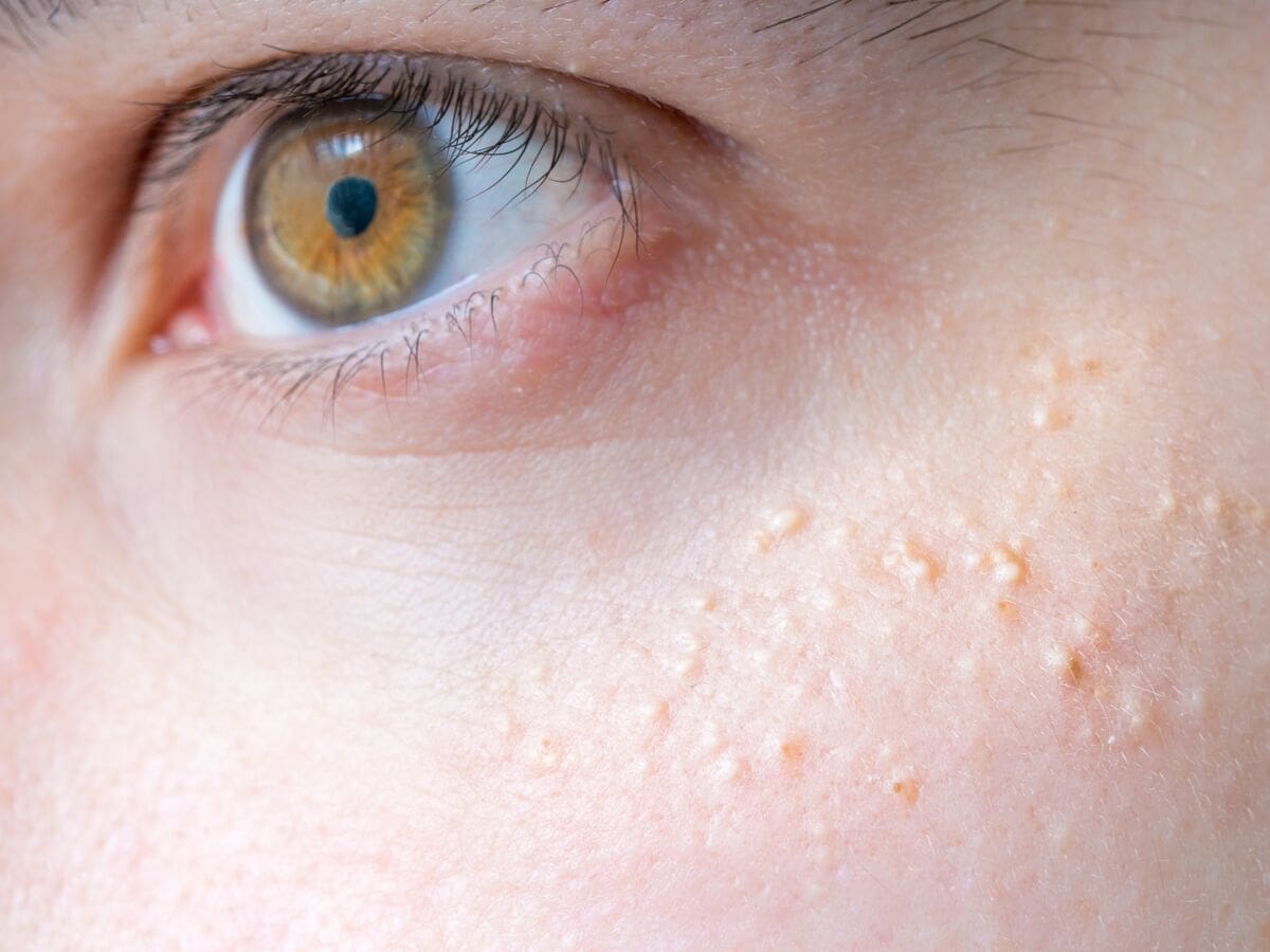 découvrez les causes et significations du bouton menton, une anomalie cutanée intrigante. apprenez à identifier ses origines, ses conséquences sur la peau et les solutions possibles pour améliorer votre bien-être. informez-vous sur ce sujet essentiel en matière de santé et d'esthétique.