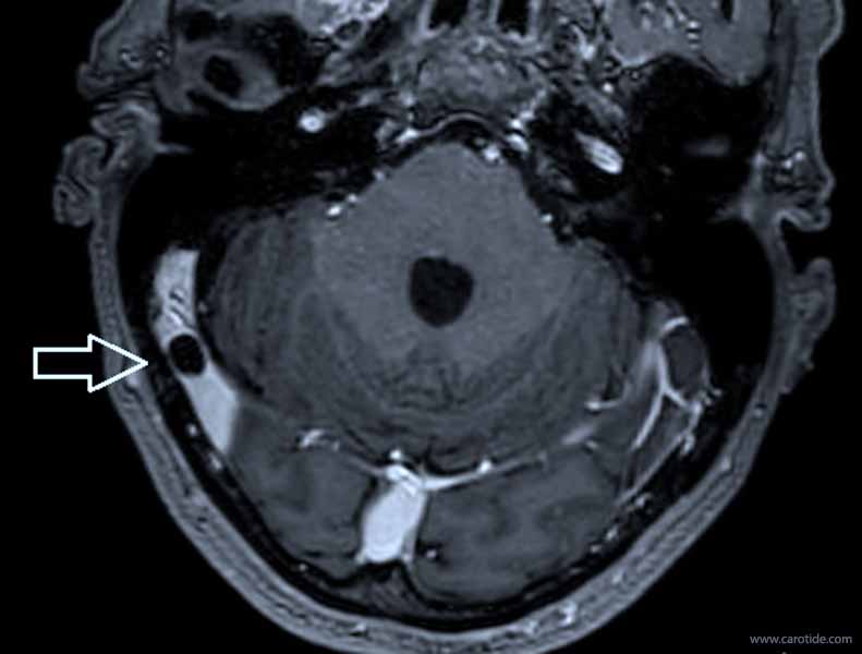 découvrez les causes possibles du sifflement à l'oreille droite, un phénomène appelé acouphène. apprenez à distinguer les symptômes, les traitements disponibles et les conseils pour soulager ce trouble auditif.