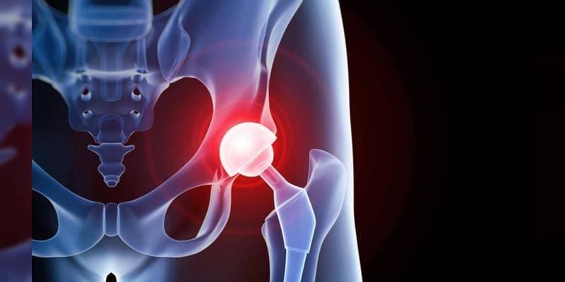 découvrez les causes, les symptômes et les traitements de la douleur à la hanche gauche. améliorez votre confort et votre mobilité grâce à des conseils pratiques et des solutions adaptées.