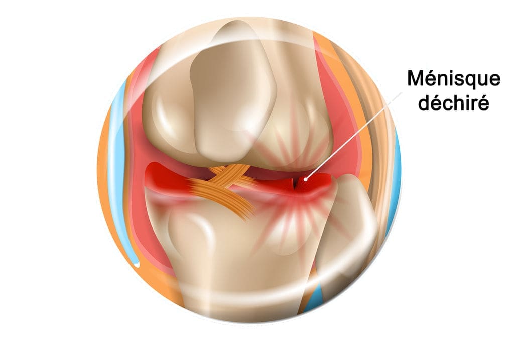 découvrez les causes possibles de la douleur au genou gauche, ses symptômes associés et les solutions pour soulager votre inconfort. conseils et traitements adaptés pour retrouver votre mobilité.