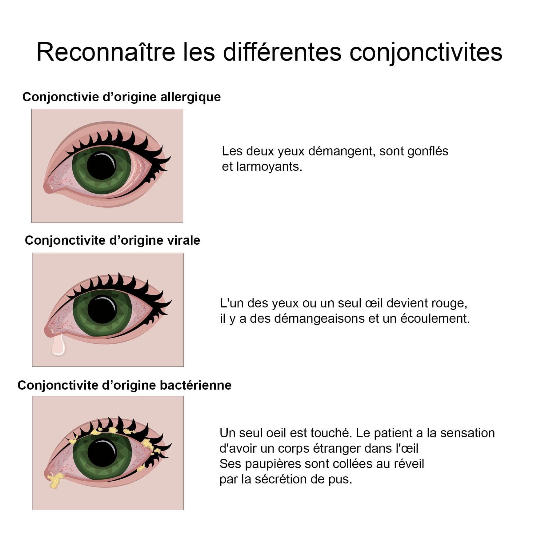 découvrez les causes possibles de la douleur à l’œil gauche, les symptômes associés, et les solutions pour soulager l’inconfort. informez-vous sur les situations nécessitant une consultation médicale.