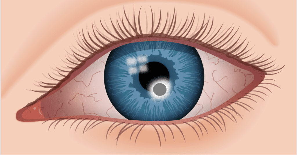 vous ressentez une douleur à l'œil gauche ? découvrez les causes possibles, symptômes associés et conseils pour savoir quand consulter un professionnel de santé. protégez votre vue en identifiant rapidement l'origine de la gêne oculaire.