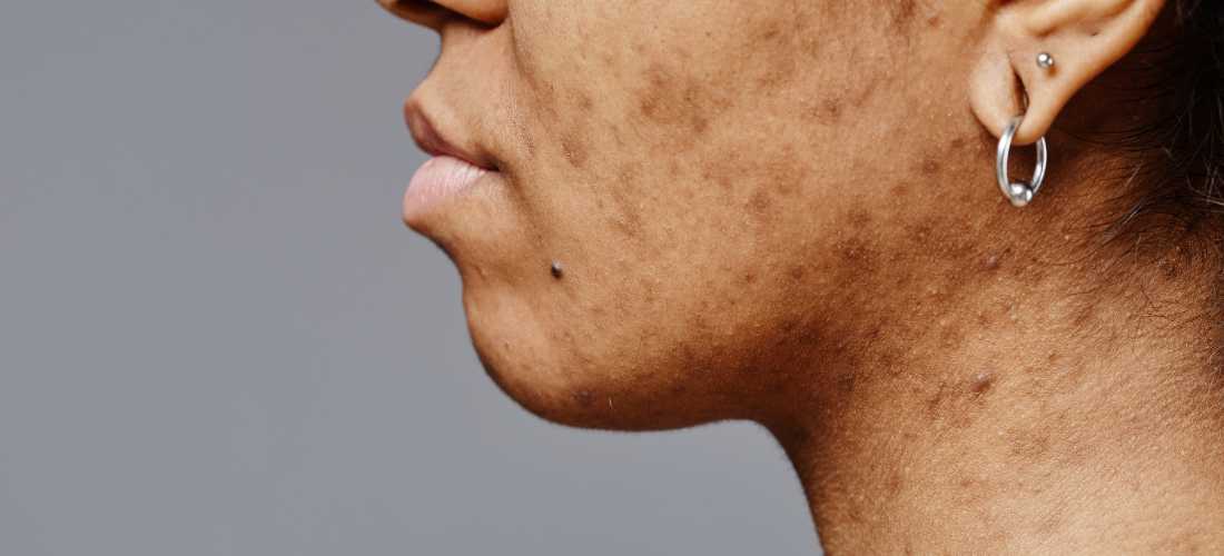 découvrez la signification d’un bouton sur le menton et les principales causes de son apparition : stress, hormones, alimentation, mauvaises habitudes... nos explications pour mieux comprendre et traiter ce problème.