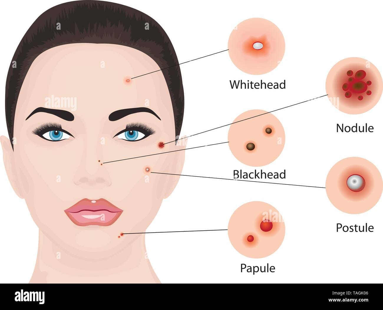 découvrez la signification des boutons sur le visage et les causes possibles de leur apparition. comprenez ce que révèle chaque zone de votre visage sur votre santé et obtenez des conseils pour les prévenir.