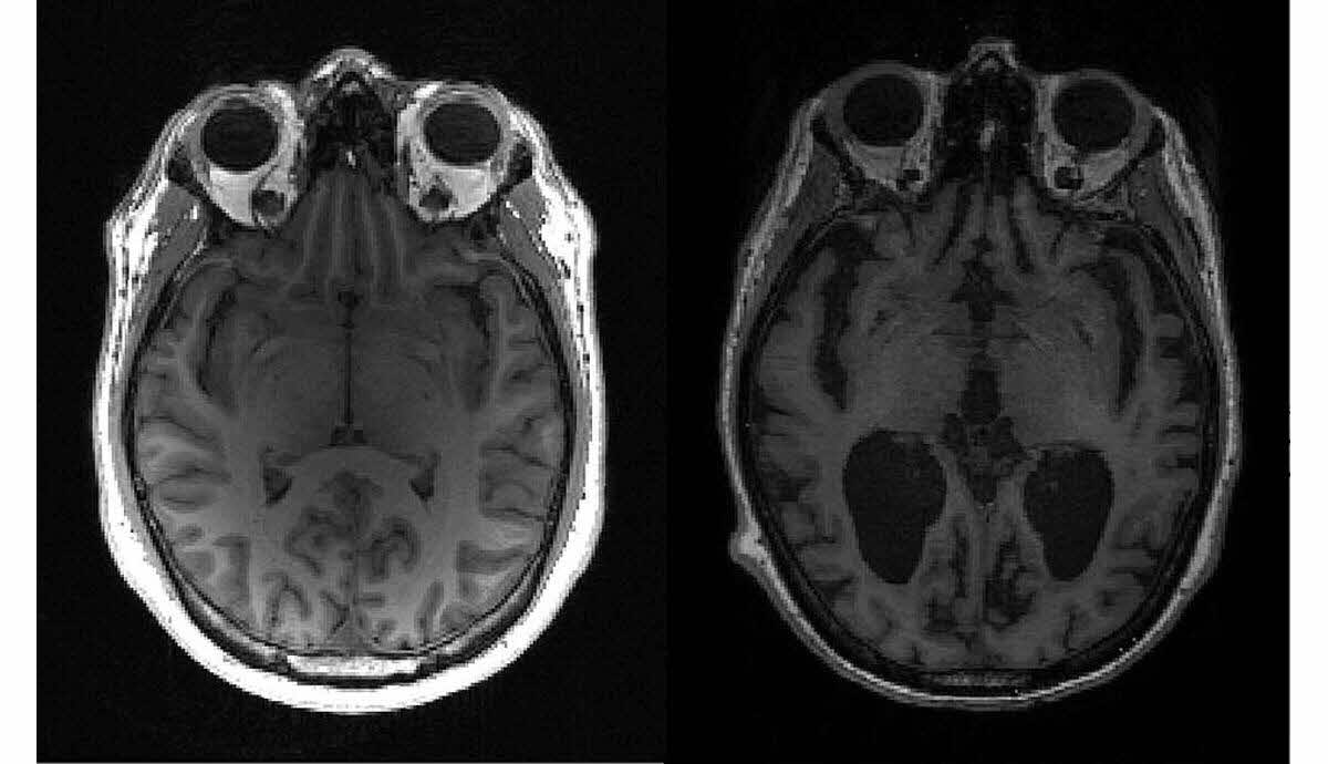 découvrez le lien entre les protéines et les maladies comme alzheimer et le cancer : explications, recherches récentes et impact sur la santé.