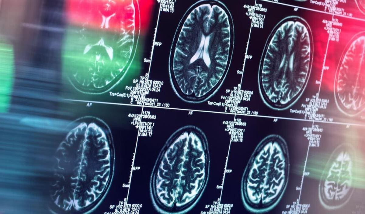 découvrez le lien entre l'usage courant des somnifères et le ralentissement de la progression de la maladie d'alzheimer, ainsi que les implications pour la santé cognitive.