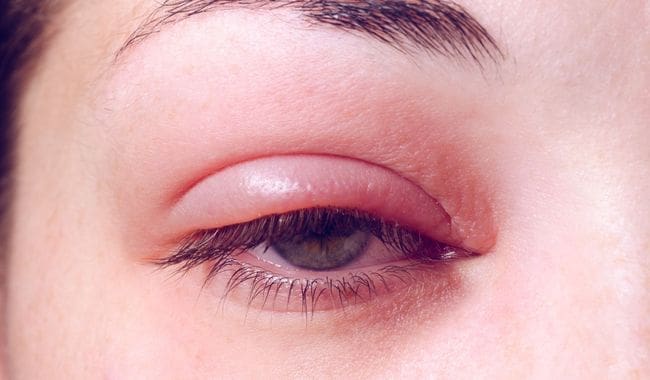 découvrez les principales causes de la douleur à l'œil gauche, les symptômes associés et les conseils pour soulager cet inconfort oculaire.