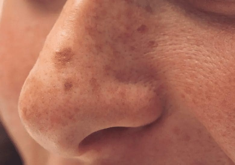 découvrez la signification des boutons sur le nez, leurs causes possibles et comment les traiter efficacement pour une peau saine.