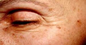 découvrez nos conseils efficaces pour la prévention des taches brunes et du vieillissement cutané, afin de préserver une peau éclatante et jeune plus longtemps.